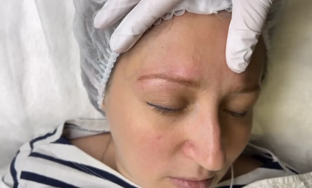 eyebrow tattooing removal